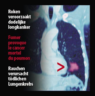 Belgium 2007 Health Effects lung - internal image, lung cancer